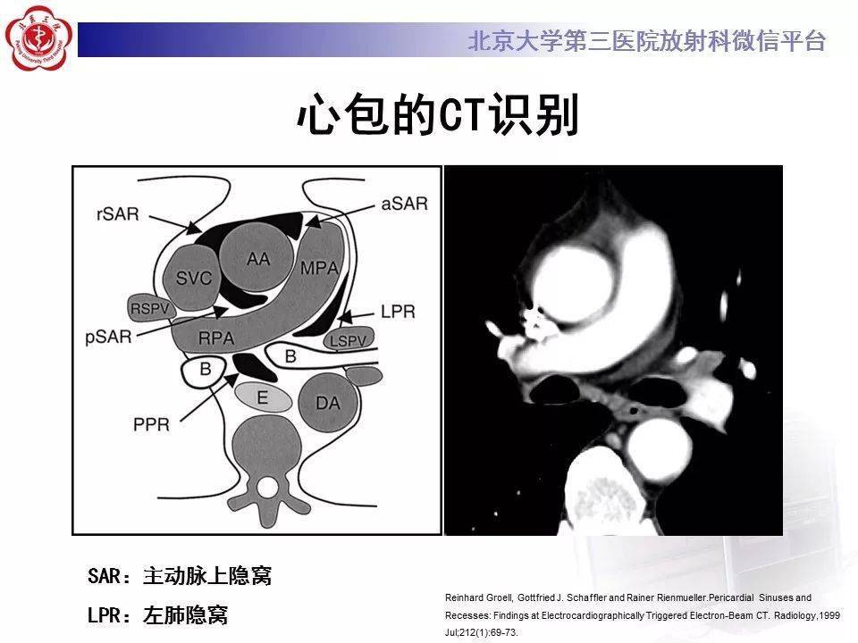 影像精美解剖丨心包窦及心包隐窝解剖建议收藏