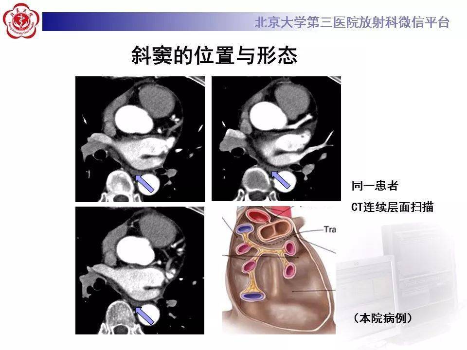 影像精美解剖丨心包窦及心包隐窝解剖建议收藏