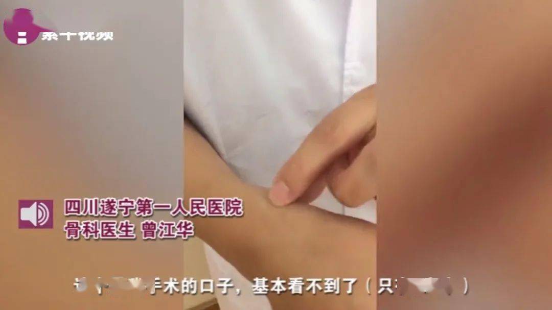 骨科医生左手给右手做手术,网友:是个狠人,佩服