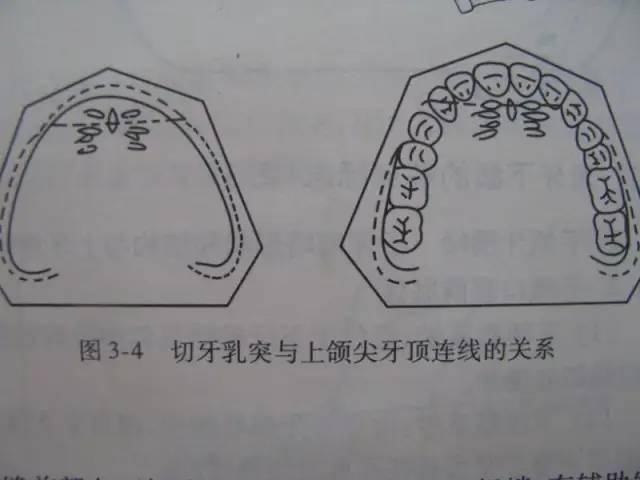 活动义齿取模技巧