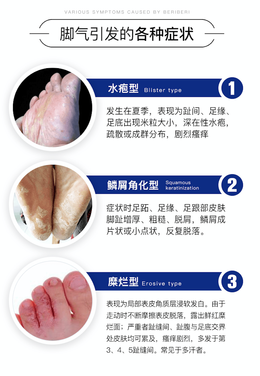 新西兰人的"脚气克星,专业拯救脚臭,脚痒!