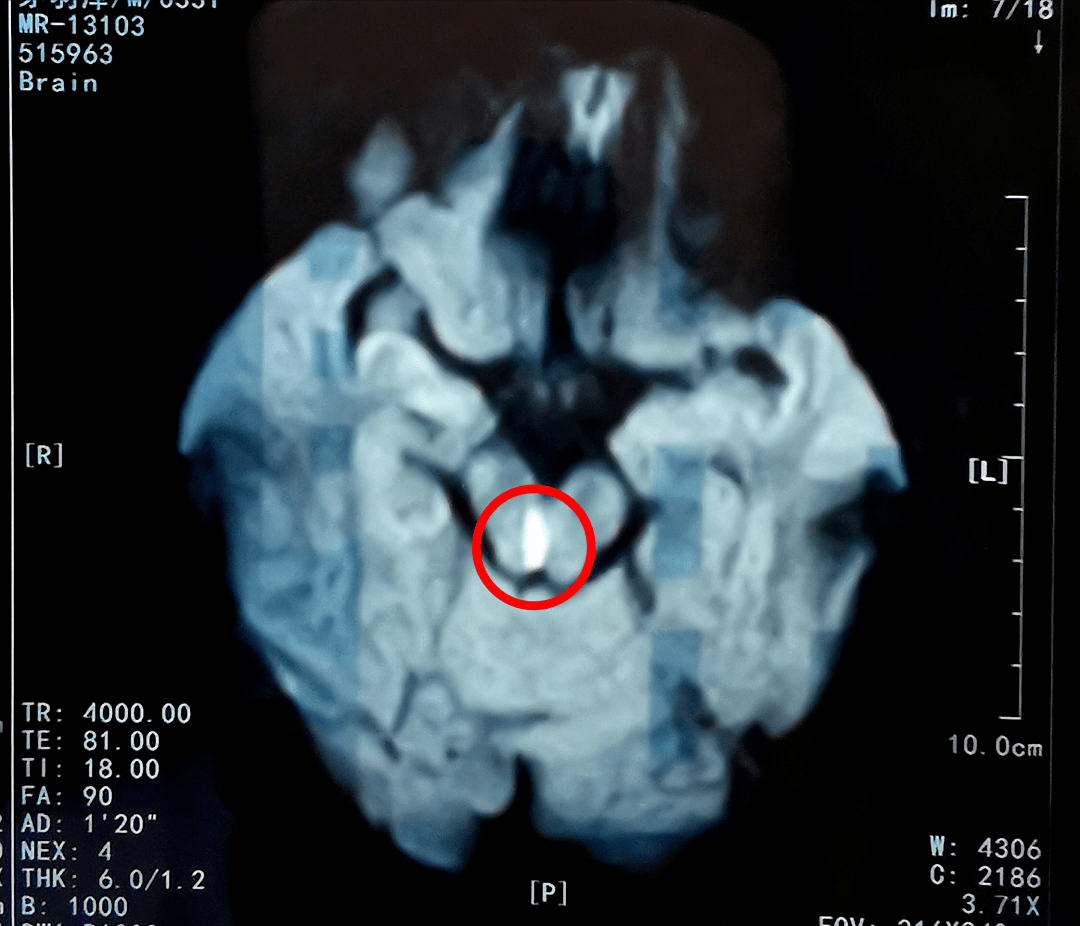 (这是小王颅脑磁共振的片子,红圈亮光处就是脑干梗死)