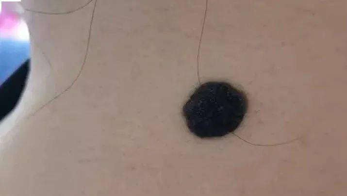 50岁,女,位于左侧乳房下面,胸罩下边缘的位置,直径7毫米左右,棕色