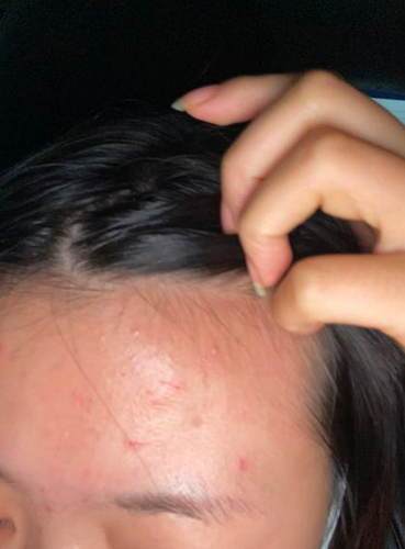 小陈|险！精装房浴室玻璃门炸裂 19岁女孩身上多处被扎伤