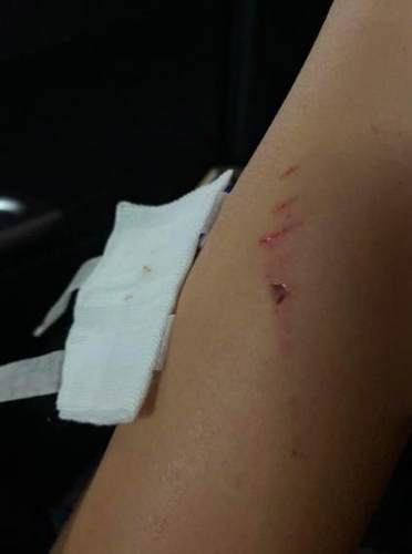 小陈|险！精装房浴室玻璃门炸裂 19岁女孩身上多处被扎伤