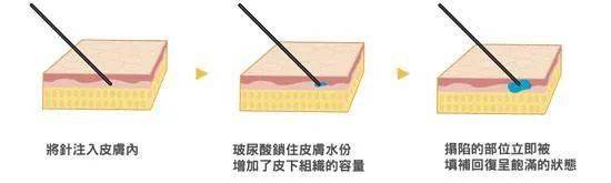 姐姐|乘风破浪的姐姐火了，没想到这些医美项目竟然也火了！