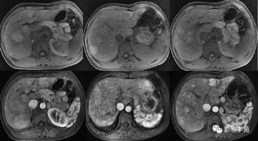 21种肝脏少见及不典型肿瘤的影像表现