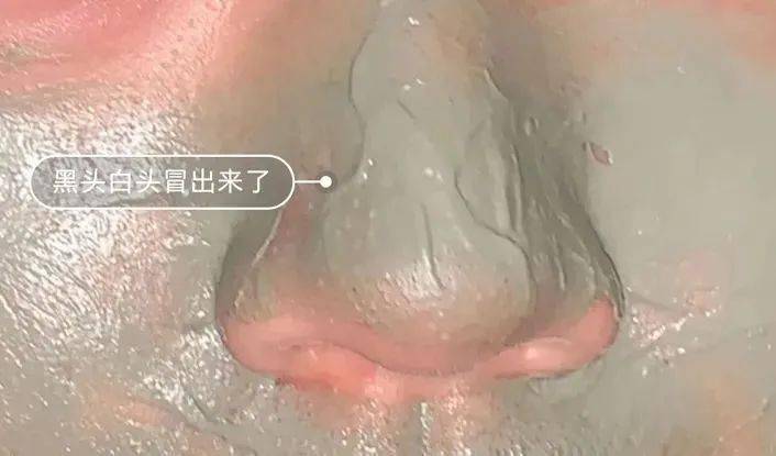 吸铁石|新西兰百年历史“污垢吸铁石”,15分钟告别黑头、粉刺、闭口!