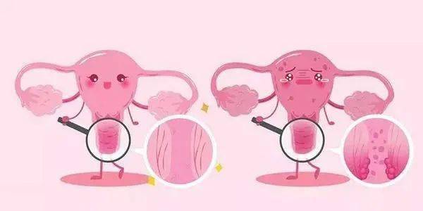 妇科知识科普 | 什么是宫颈癌?如何预防?