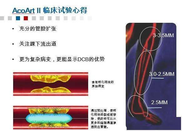 药涂球囊——糖尿病足患者的新希望