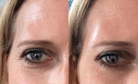 效果|震撼黑科技！搞定眼袋、细纹、浮肿、黑眼圈……效果比PS还好！