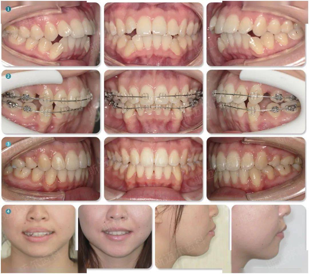 矫正方法:拔除4颗前磨牙,矫正时间2年,改善前突,排齐全口牙列,调整面