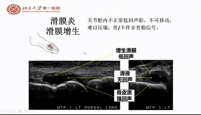 肌骨超声诊断关节炎敏感,高效 1 肌骨超声在类风湿关节炎(ra)中的