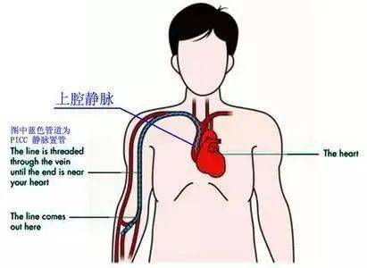 测量cvp，只可以使用cvc吗？