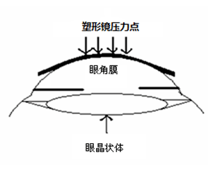 塑形镜作用原理示意图