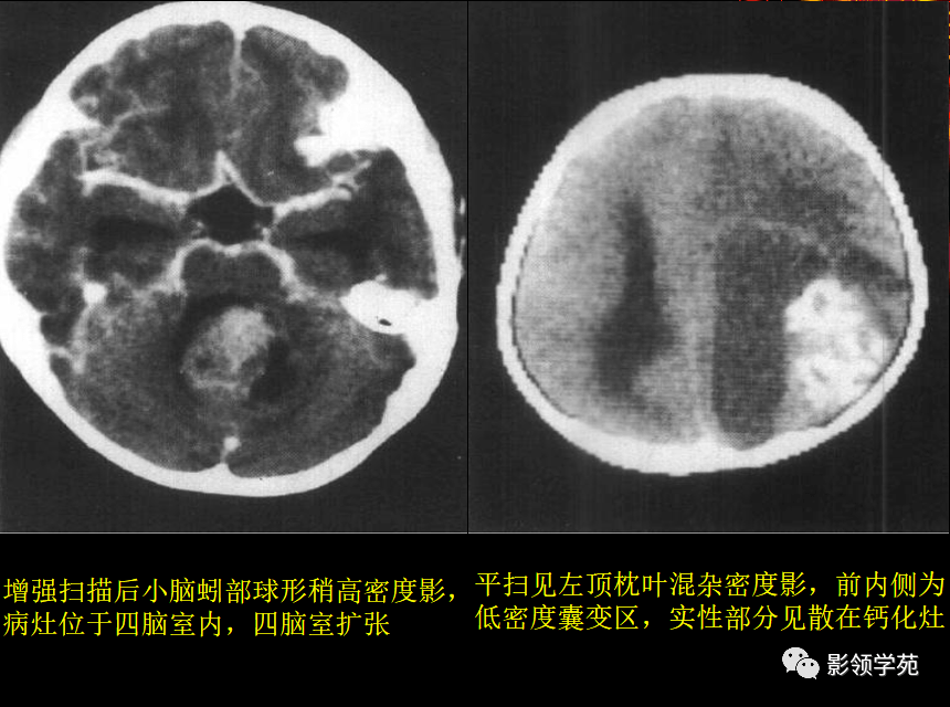 强化明显,脑室积水(4)部分室管膜瘤可发生在脑实质内,以顶枕叶为多见