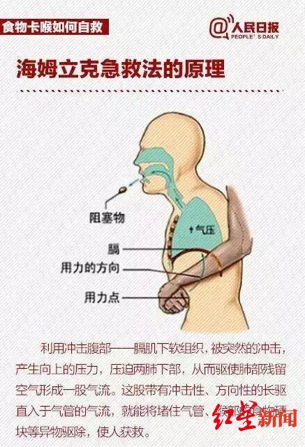 海姆|飞机上2岁女孩气管被卡窒息，有个华西医生恰好在航班上……