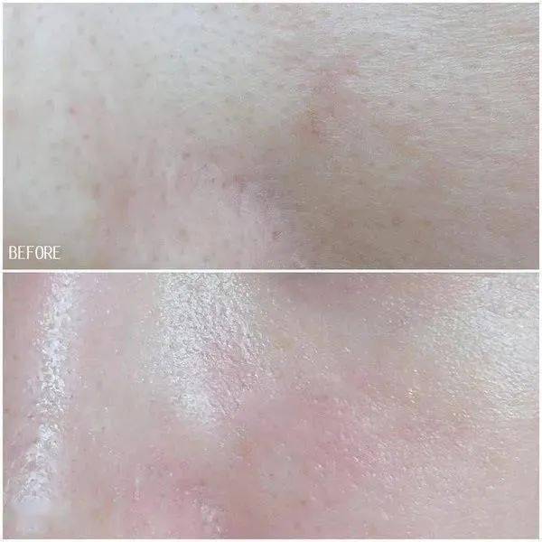 祛痘|30秒get医美“刷酸” ，从此和痘痘大毛孔形同陌路！