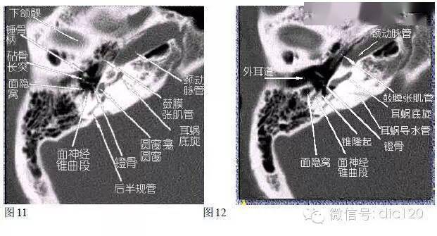 影像解剖 | 史上最全的耳部ct及mri解剖,抓紧收藏