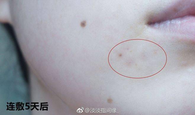 灭火器|1滴让你爱上!从满脸爆痘到光滑无瑕,我只用了这瓶火爆ins的“痘痘灭火器”!