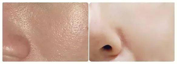 肌肤|脸上挤出的“白浆”是什么？原来是它作怪！出油、过敏也因此而起！