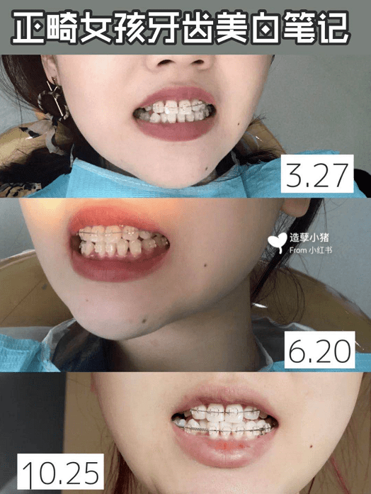 牙膏|牙黄真的太毁颜值！连涂口红都没人家好看