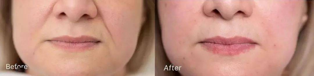 皱纹|抗皱抗衰老还在打针?用它赶走三八脸、鱼尾纹,让小朋友见到你都喊姐姐!