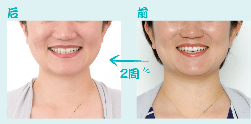 爆表|赵丽颖生娃后甜美度爆表,紧致脸部线条的漱口法拥有同款少女颜!