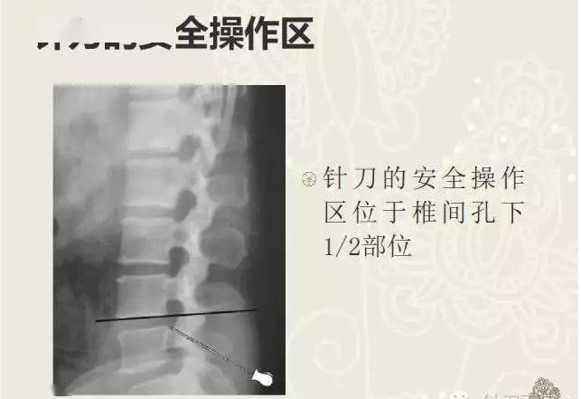 腰椎棘突在针刀定位治疗中的应用