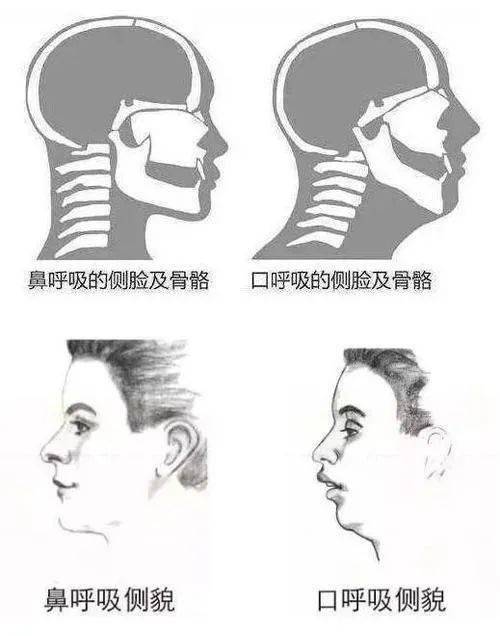 由于口呼吸造成血氧量降低,长期对儿童的心智精神健康和肌肉稳定度有