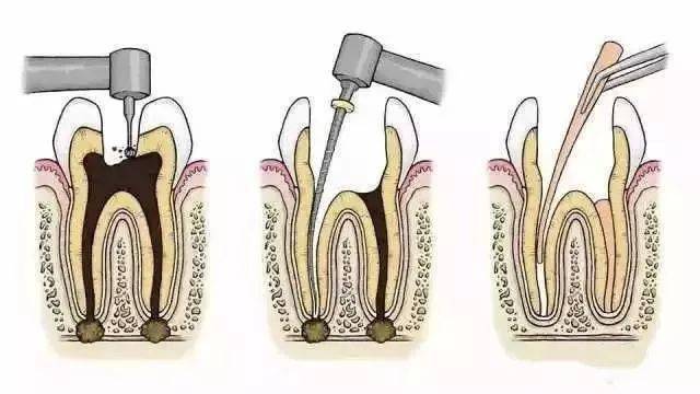 至少要保证3张牙片 治疗前 帮助医生了解牙根的基本情况,制定治疗计划