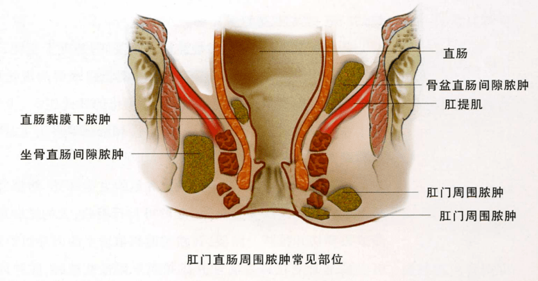 直肠|医学科普︱屁屁很痛，竟然得了“肛周脓肿”！