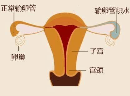输卵管结核性阻塞:输卵管管壁增厚呈结节状,伞端可以开放或闭锁,多数