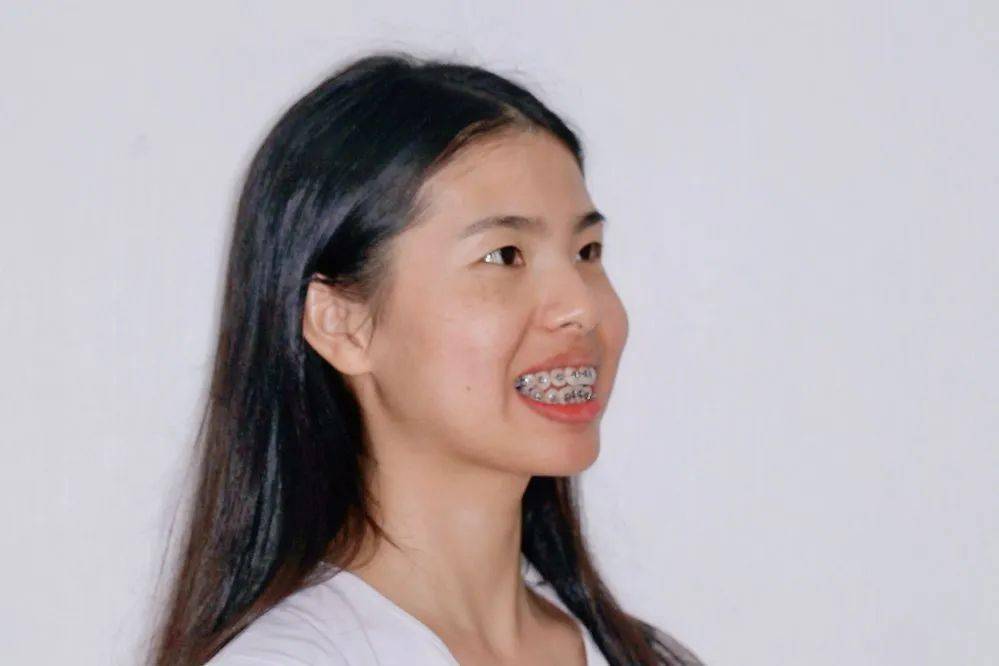 龅牙|广州95后女生从小龅牙，嘴巴都快闭不上！朋友却劝她不要矫牙，一年后......