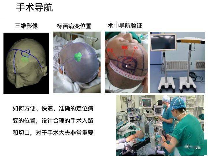 智慧神外 协和医院冯铭:大数据和人工智能在神经外科中的应用(访谈及