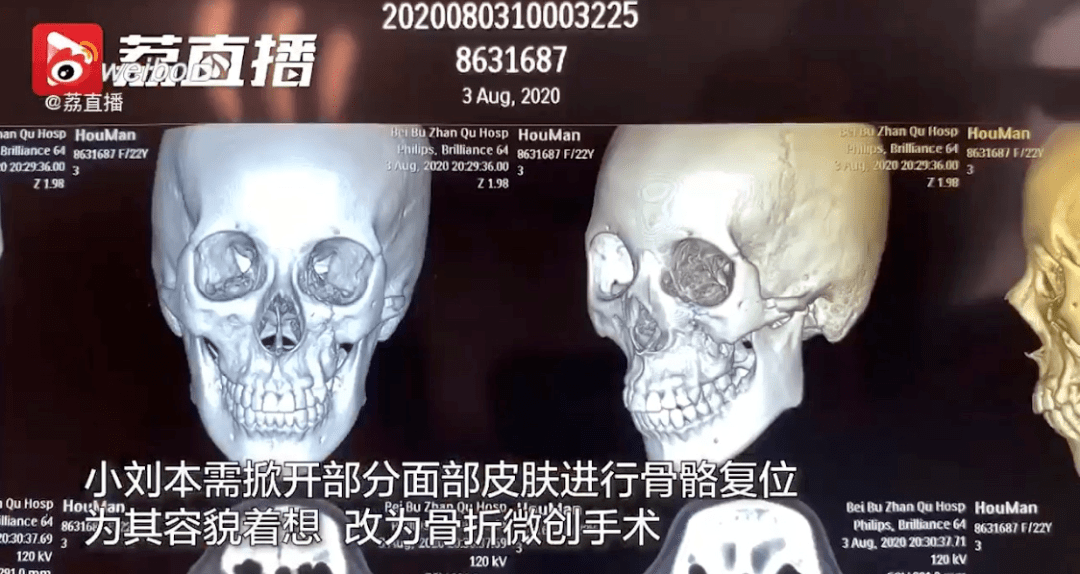 巨浪|还敢“乘风破浪”吗？23岁女孩玩水时被人造浪掀飞，脸部4处骨折！