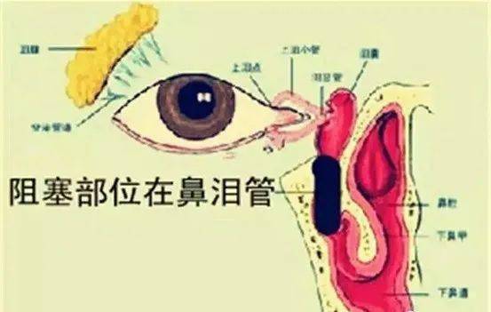 经常流泪流眼屎当心泪道阻塞泪囊炎