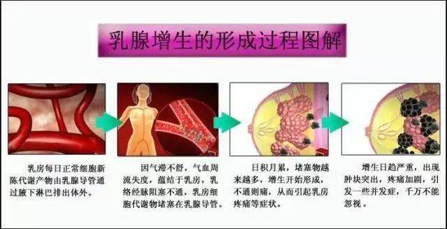 两个穴位治好乳腺增生