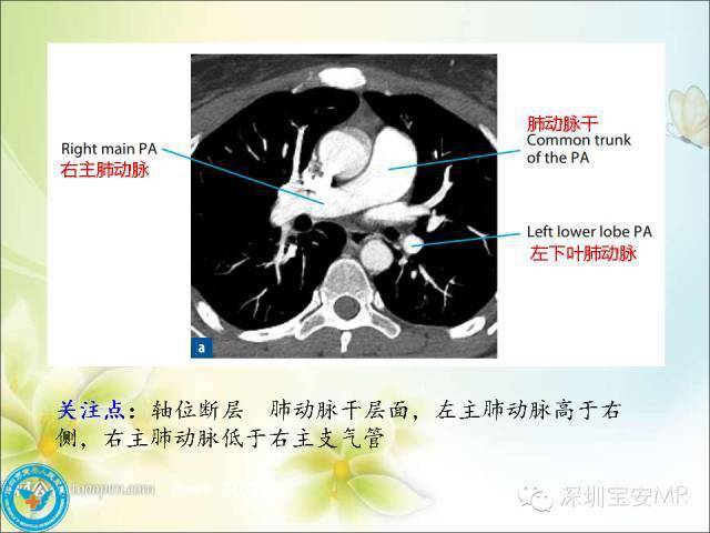 解剖心脏大血管丨肺动脉和肺静脉影像断层解剖