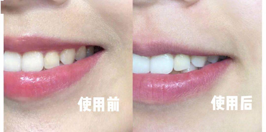 口腔|张嘴闭嘴还口臭？该怎么拯救？