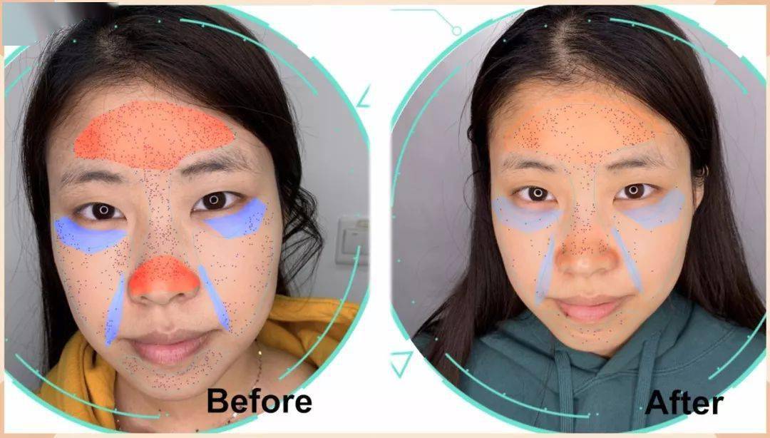 蒜头鼻图片示例 f1ac71cb2e914e74a58e511b8a6b4d2f.jpeg