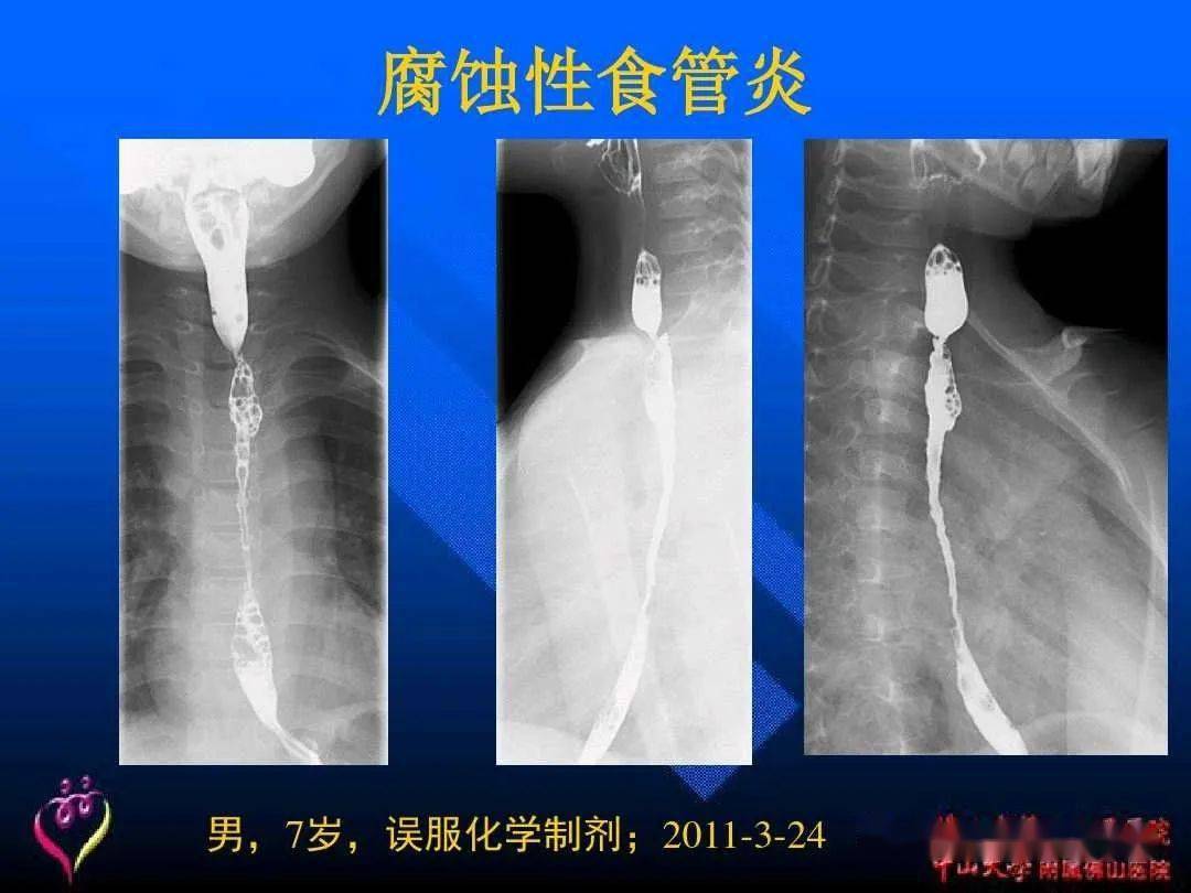 超详细的消化道造影正常与异常影像图解