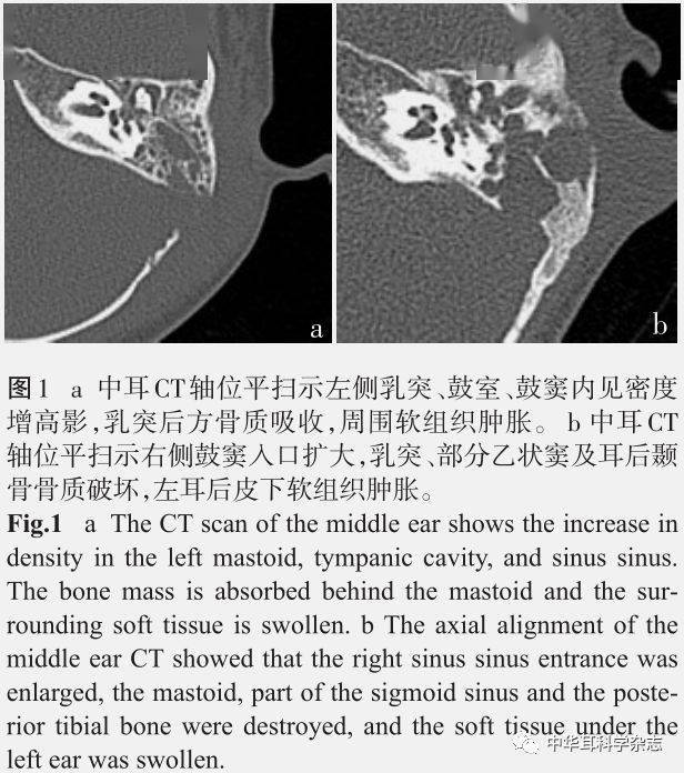 中耳炎并发耳后骨膜下脓肿临床诊疗探讨