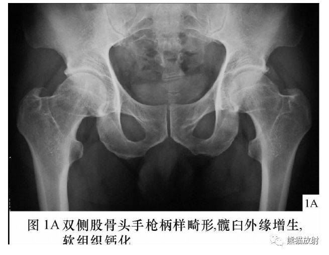 髋关节撞击综合征fai丨影像表现