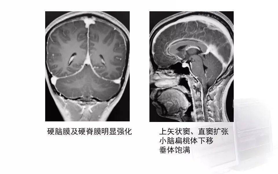 【学习】低颅压综合征