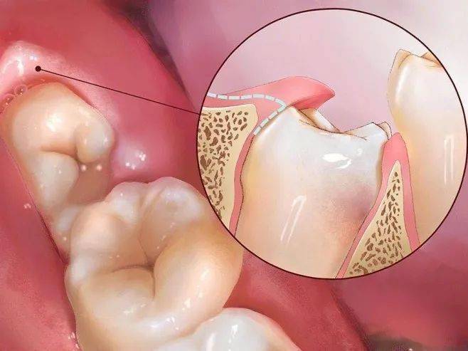 冠周炎 智齿倾斜牙龈就会形成盲袋,盲袋内就容易藏入食物残渣及菌斑