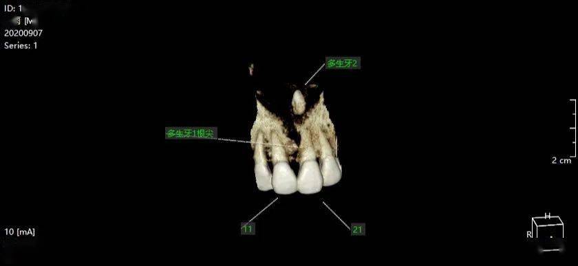 38 48均双根,近中水平位低位阻生,近中根尖压迫同侧下颌神经管上壁.