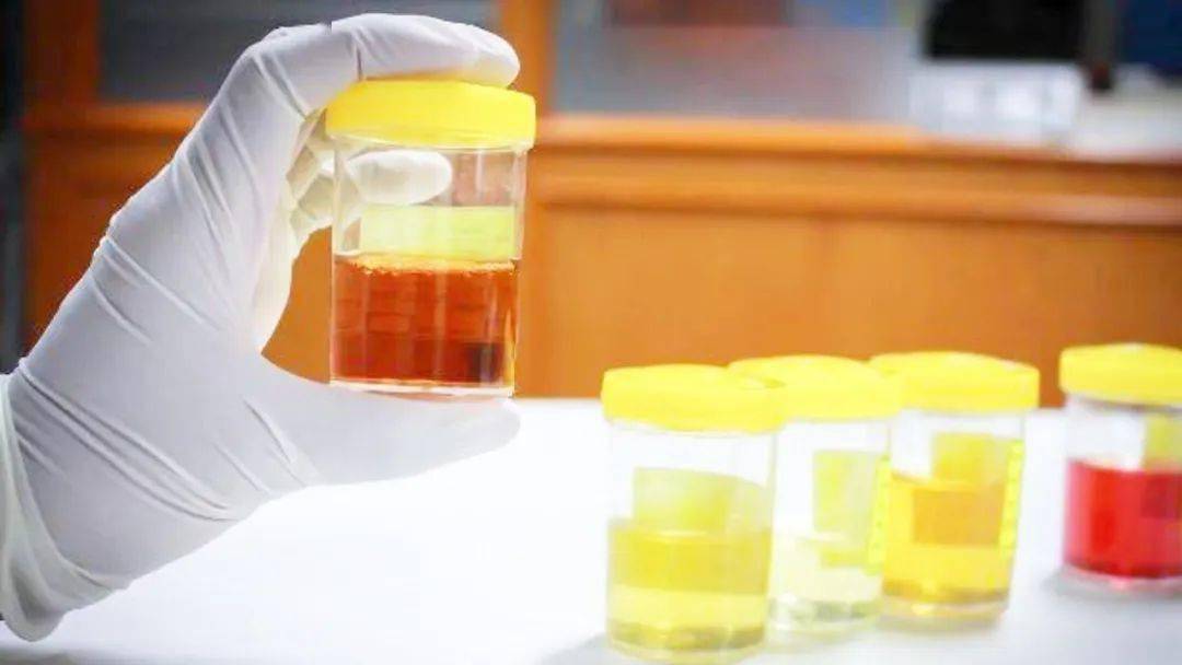 肾脏|上厕所时，若有这种异常，可能是你体内尿酸高了，需及时控制！