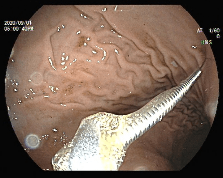 幼儿|广东3岁幼儿误吞4cm灸针！家长吓得哭出声：我太后悔了…