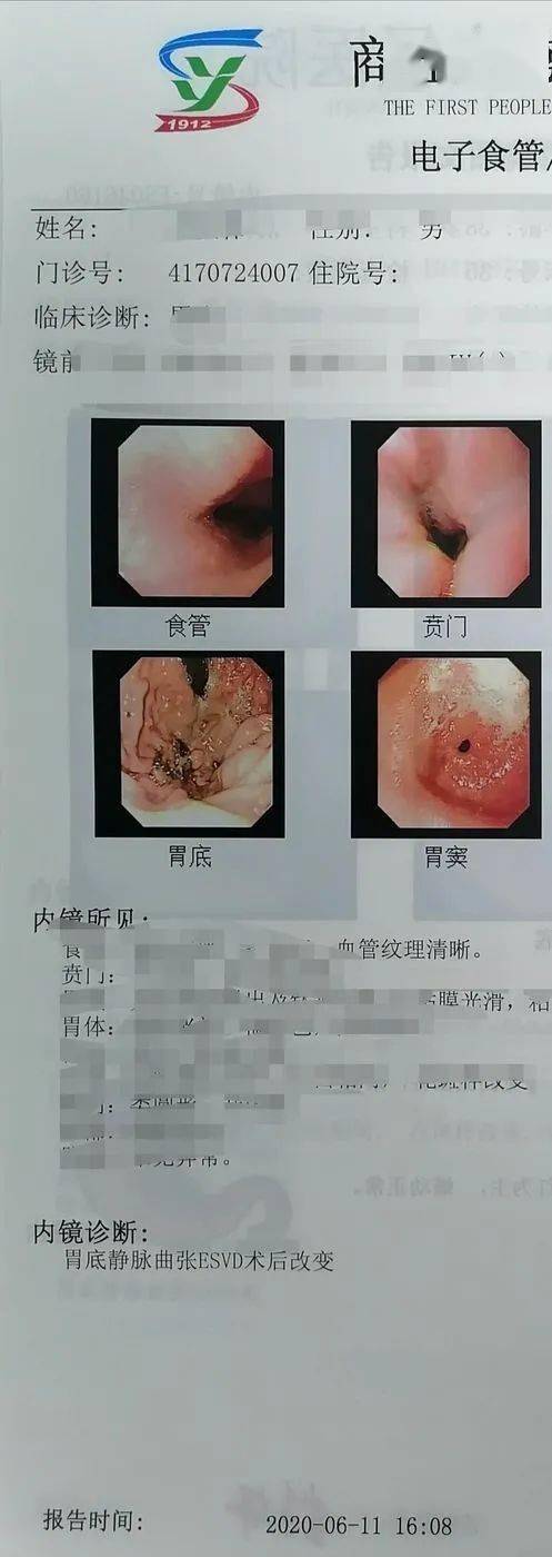 内镜下钛夹联合组织胶聚桂醇治疗胃底巨大静脉曲张1例